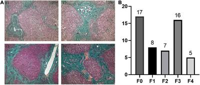 TGF-β1-Mediated Leukocyte Cell-Derived Chemotaxin 2 Is Associated With Liver Fibrosis in Biliary Atresia